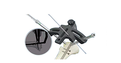 PEEK Femoral and Tibial Gamma Intramedullary Nail Aiming Instrument